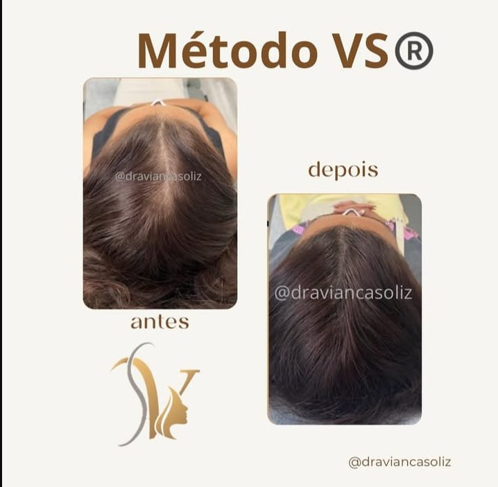 Antes y después capilar 3