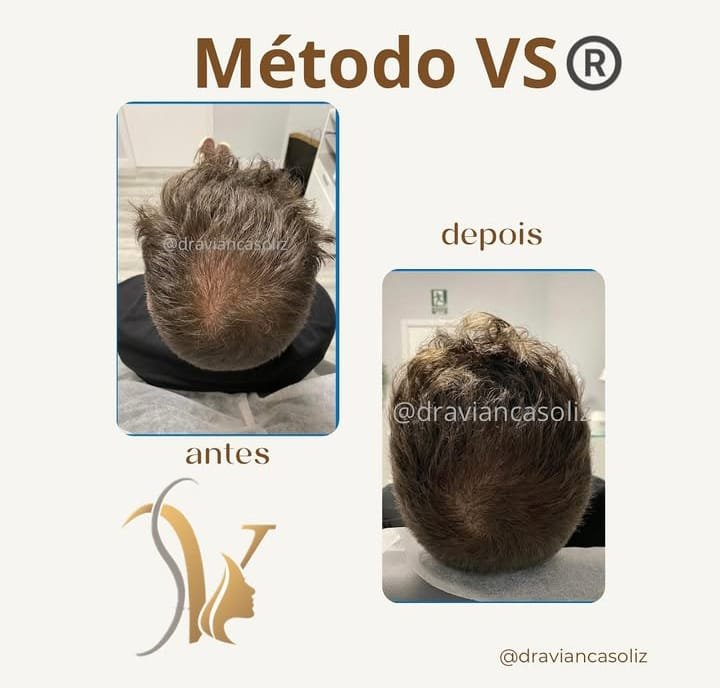 Antes y después capilar 4