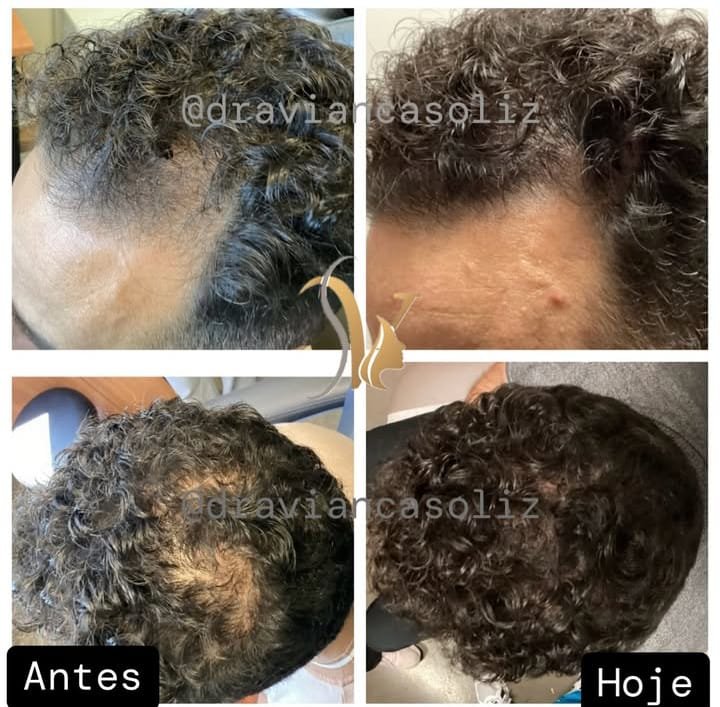 Antes y después capilar 5