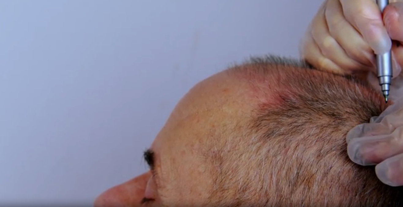 Bastidores del tratamiento